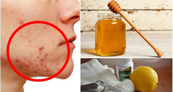 treating cystic acne naturally
