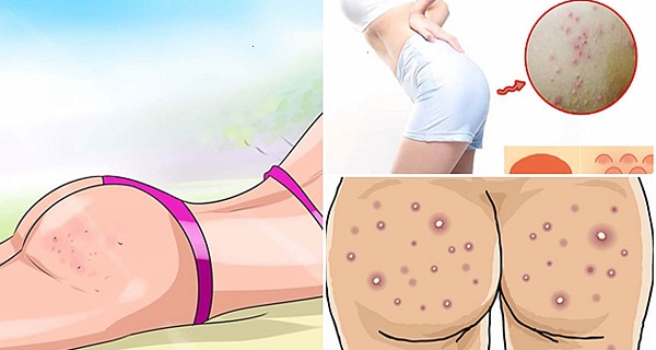 Yeast infection sores on buttocks