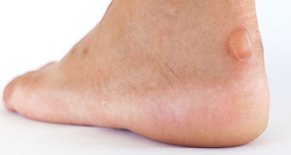 When You Have A Big Blister On Your Foot, Follow These 4 Steps And Eliminate It Naturally!