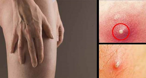 If You Have Boils In Groin Area, Legs And Thighs, Eliminate Them Naturally Using This!