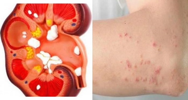 early signs and symptoms of kidney disease