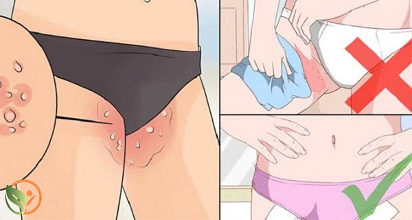 fungal yeast infection on skin