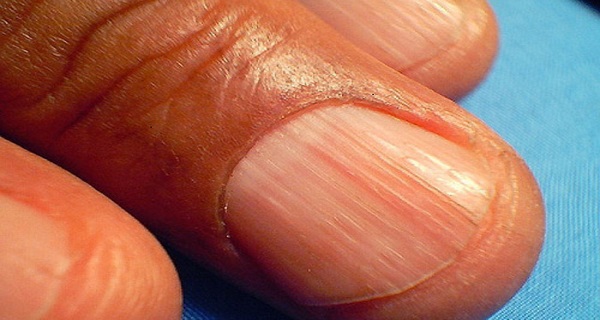 grooves in nails
