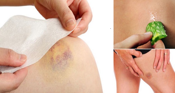 See How To Cover Up A Bruise Using One Of These Efficient Homemade Remedies!