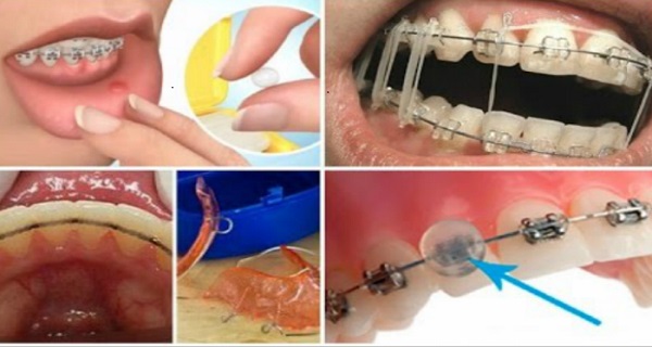 how to get rid of sores from braces