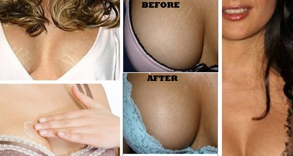 Heal Severe Stretch Marks On Breasts Or Prevent Them From Appearing Using This!