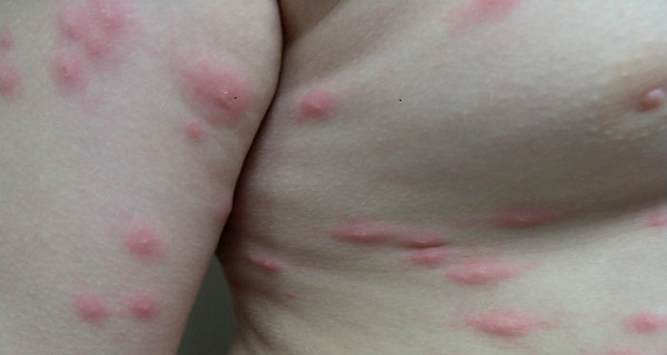 atopic dermatitis blisters