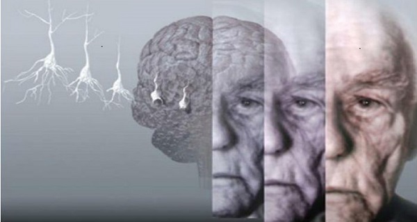 what gene causes Alzheimer’s disease