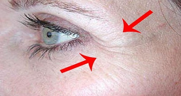 Learn How To Get Rid Of Smile Wrinkles Around Your Eyes And Lips Using A Natural Remedy