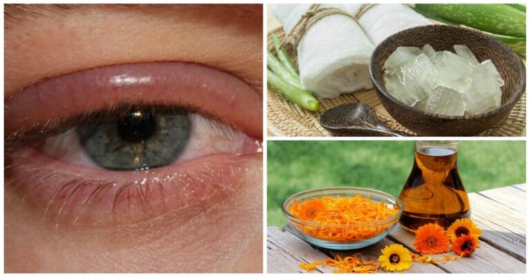 Get Rid of Redness Around Eyes and Eye Infections Using These Home Remedies!