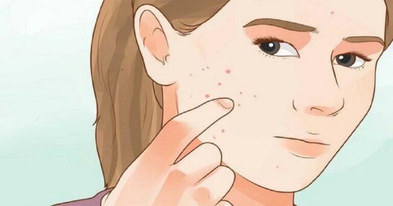 What Types of Acne Scars Exist and How to Recognize Them?