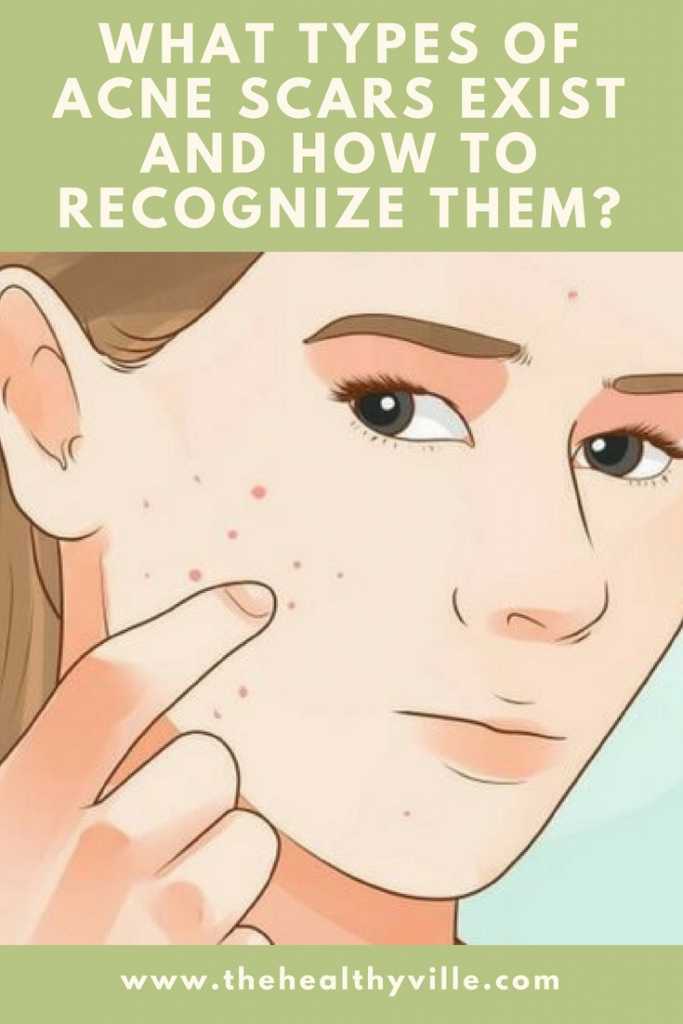 types of acne scars pin
