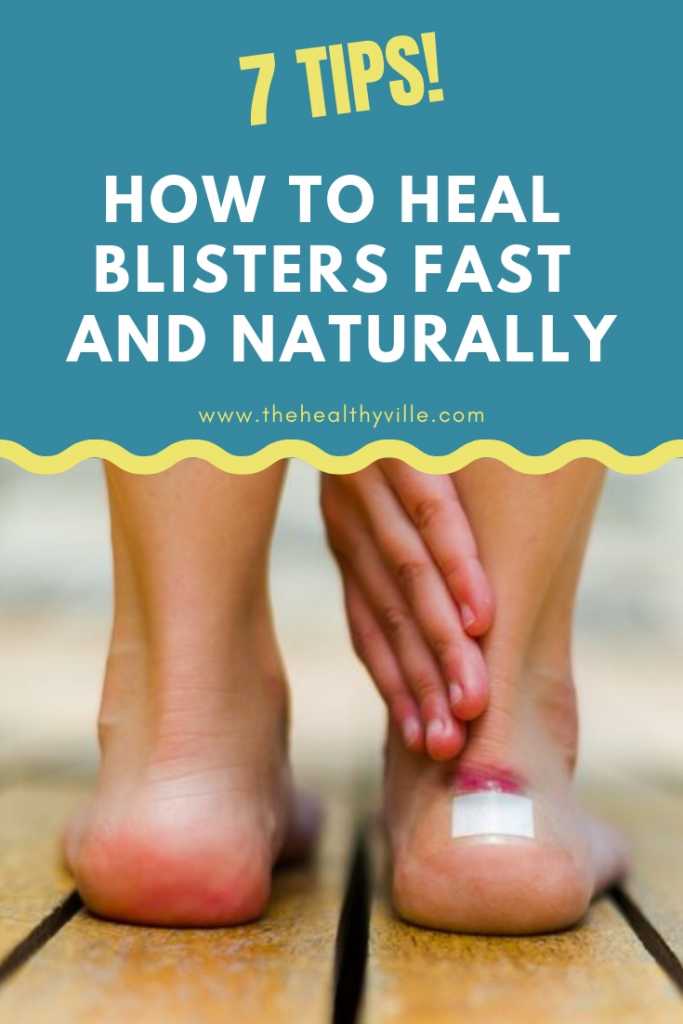 Learn How to Heal Blisters Fast and Naturally – 7 Tips