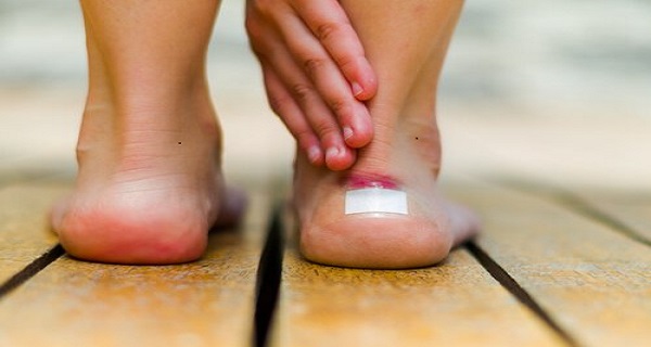 Learn How to Heal Blisters Fast and Naturally – 7 Tips
