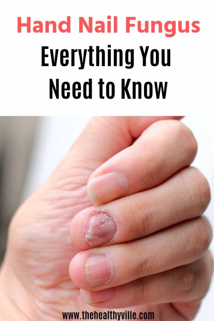Hand Nail Fungus_ Everything You Need to Know