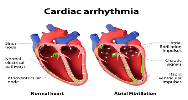 what are the symptoms of AFIB
