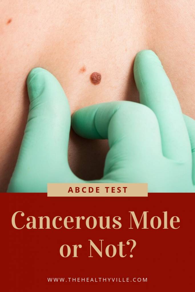 Cancerous Mole or Not_ Perform the ABCDE Test and Find Out!