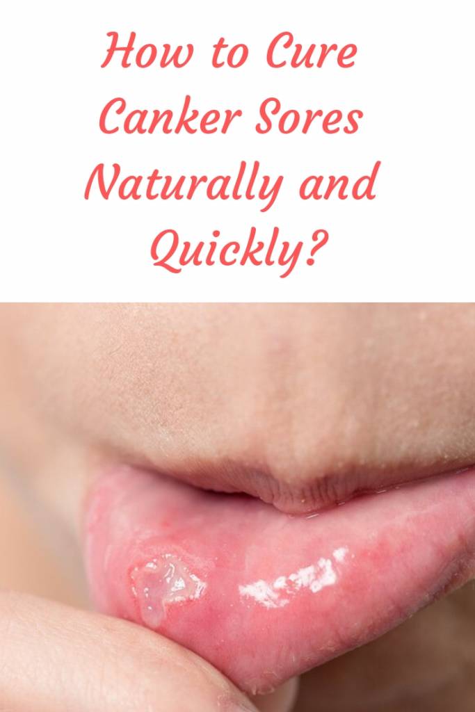 Learn how to cure canker sores quickly, using natural remedies, and get rid of the annoying pain before it gets worse.