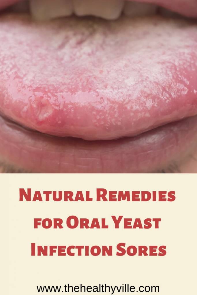 Natural Remedies For Oral Yeast Infection Sores