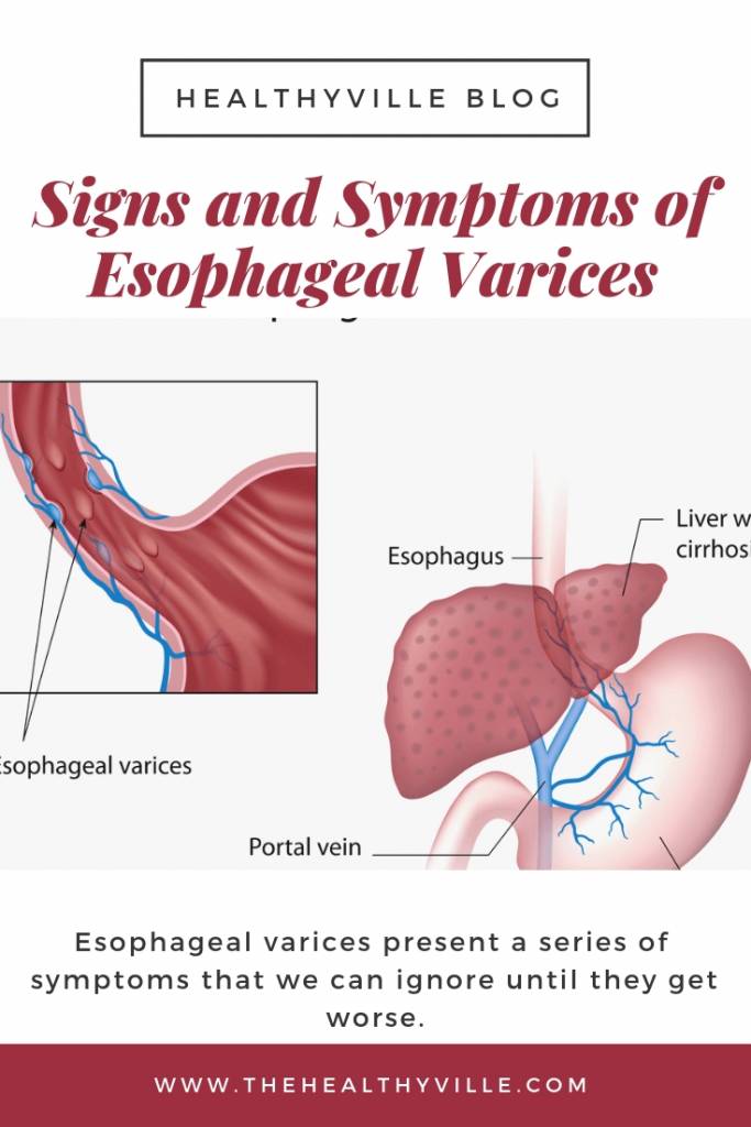 Signs and Symptoms of Esophageal Varices