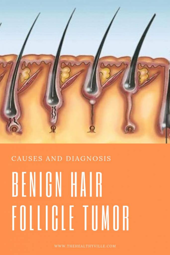 Benign Hair Follicle Tumor – Causes and Diagnosis
