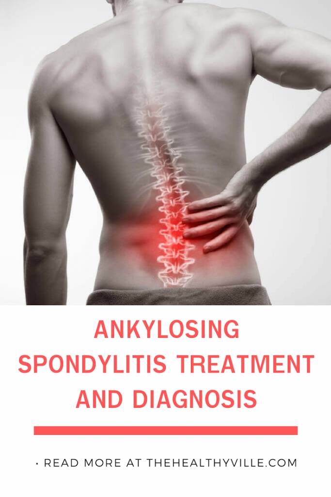 Ankylosing Spondylitis Treatment and Diagnosis