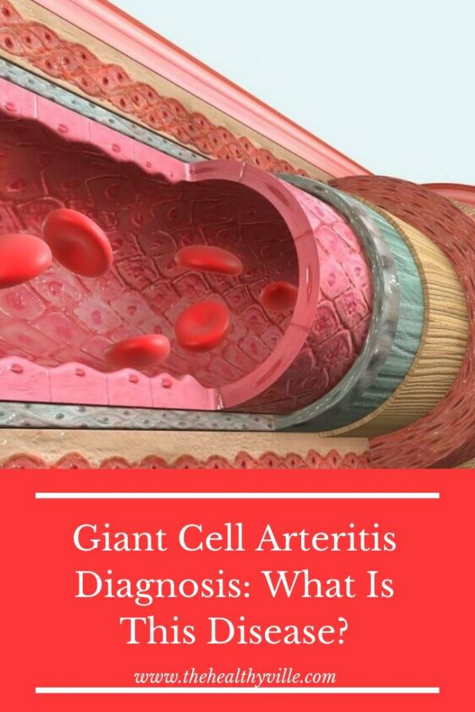 Giant Cell Arteritis Diagnosis_ What Is This Disease