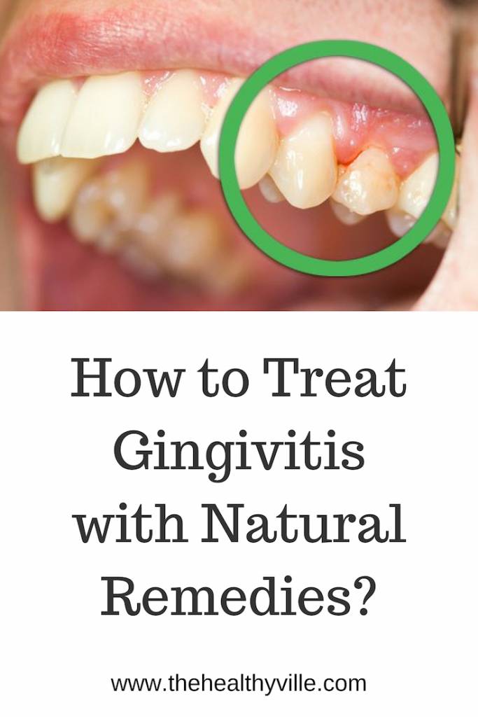 How to Treat Gingivitis with Natural Remedies