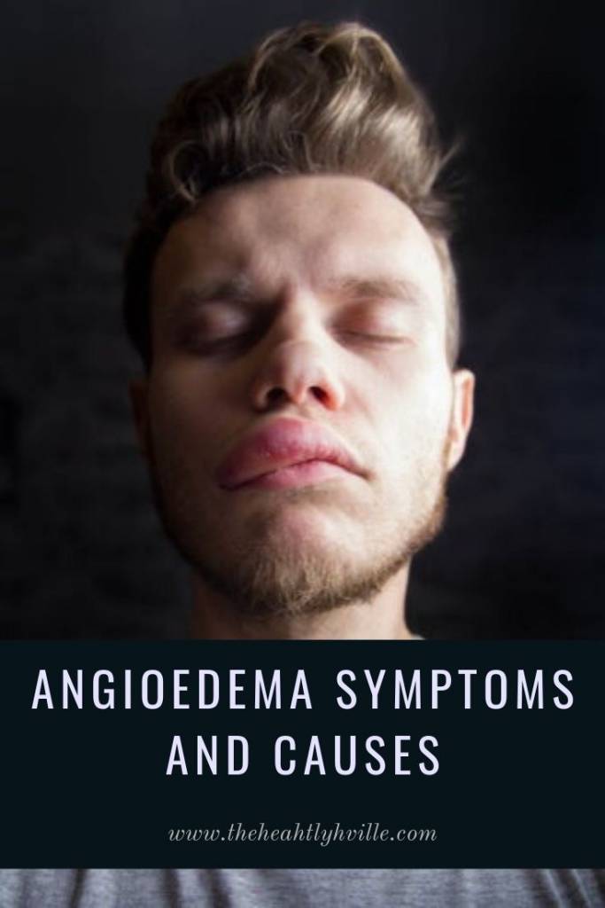 Angioedema Symptoms and Causes