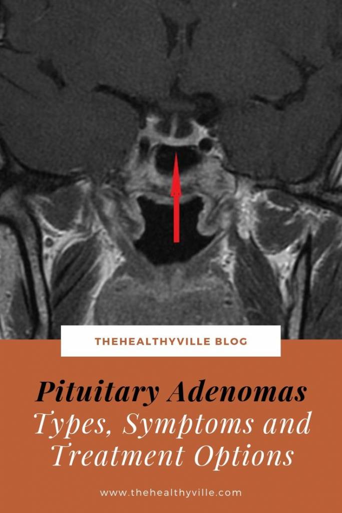 Pituitary Adenomas_ Types, Symptoms and Treatment Options