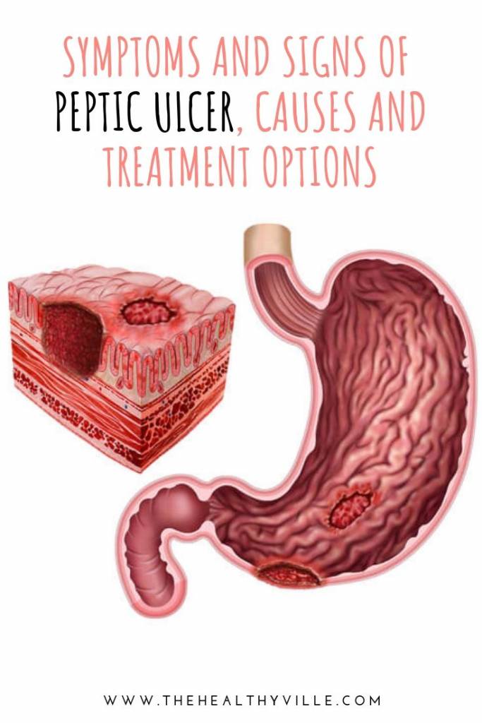 Symptoms and Signs of Peptic Ulcer, Causes and Treatment Options