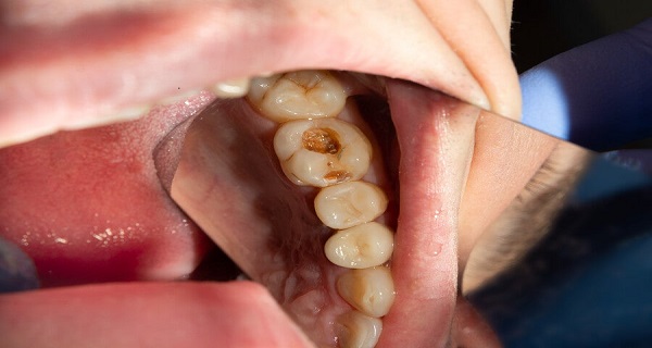 dental caries
