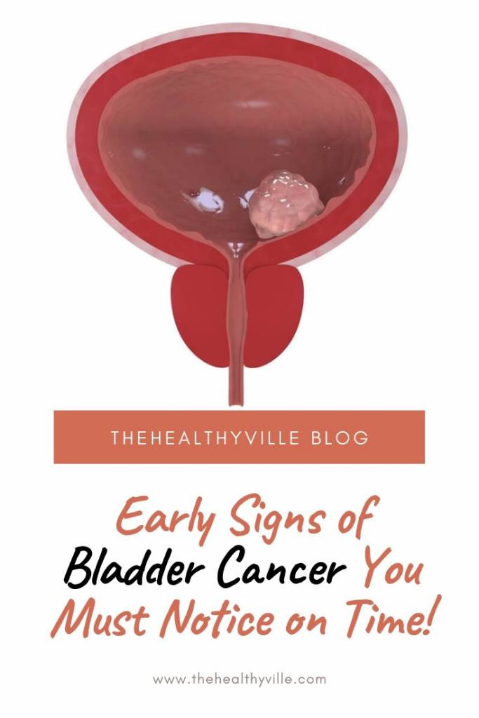 Early Signs of Bladder Cancer You Must Notice on Time!