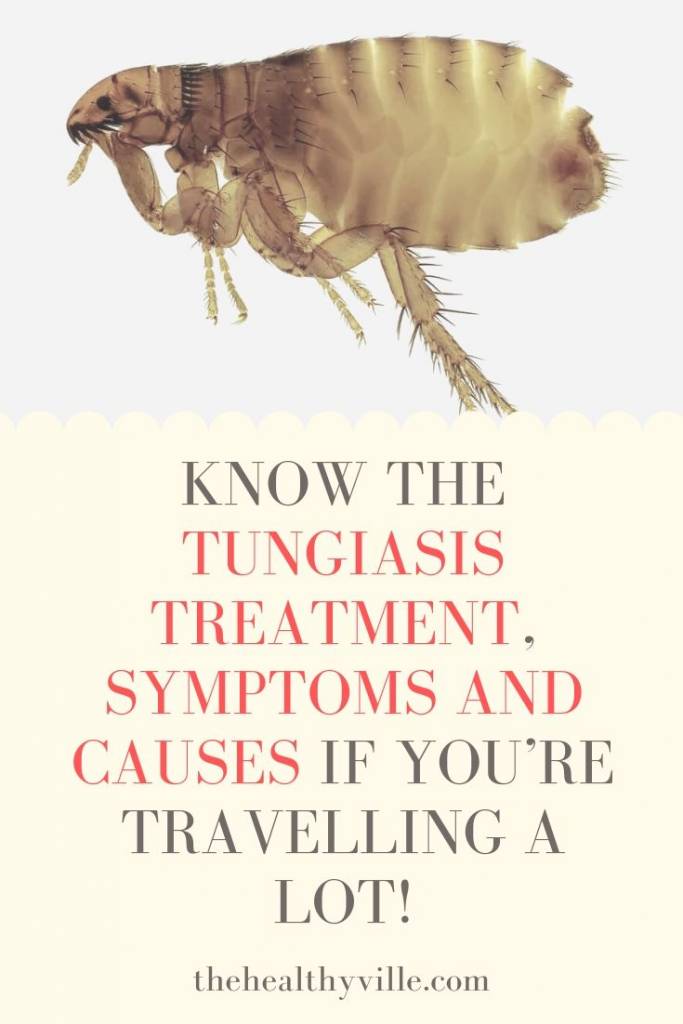Know the Tungiasis Treatment, Symptoms and Causes If You’re Travelling a Lot!