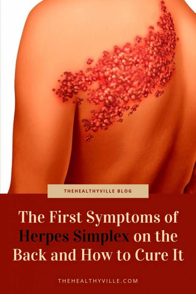 The First Symptoms of Herpes Simplex on the Back and How to Cure It