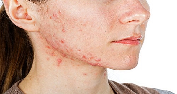 tretinoin benefits