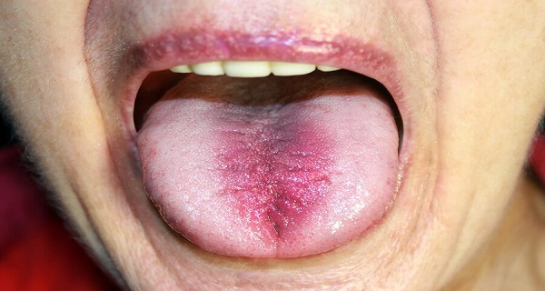 What Causes  afire Mouth Syndrome and How to Treat It?
