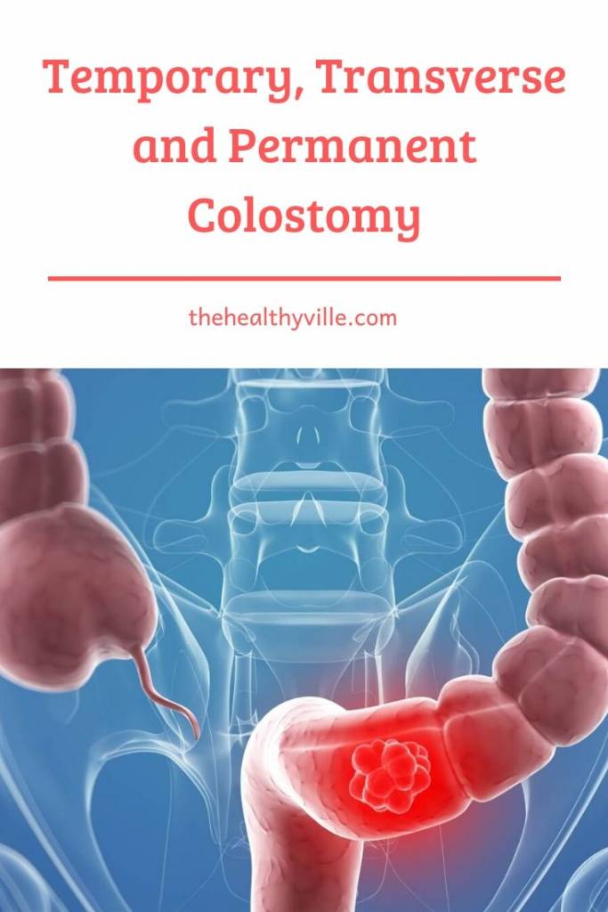 Temporary, Transverse and Permanent Colostomy – What Are They_
