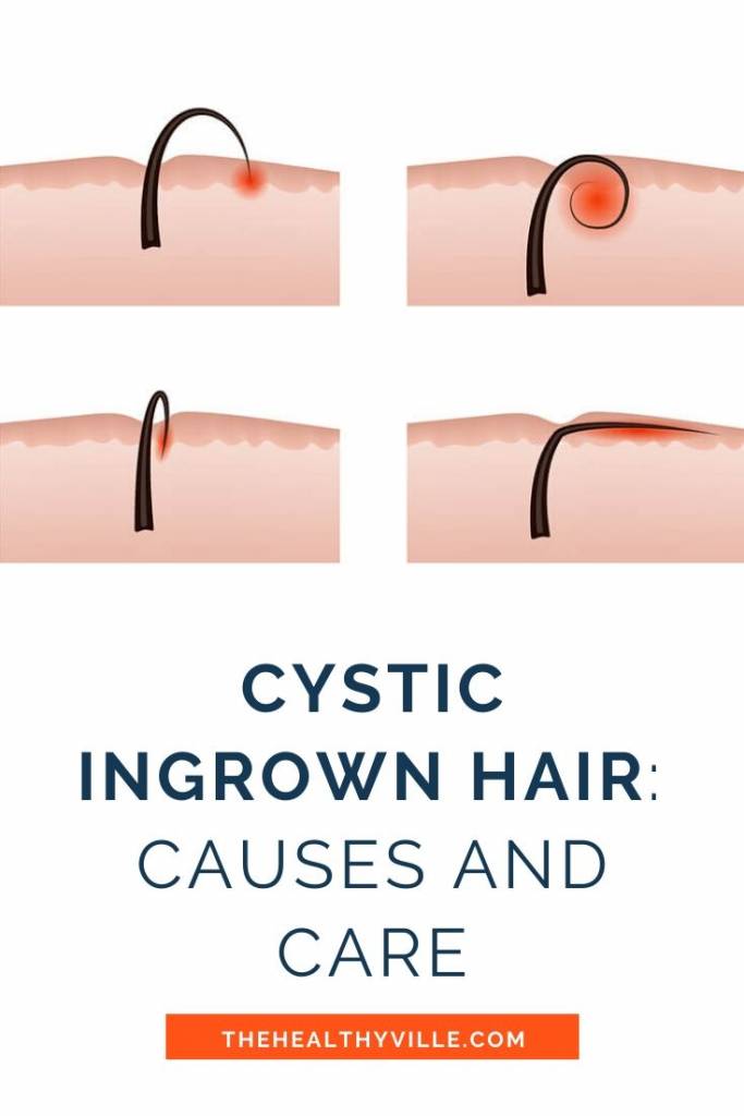 Cystic Ingrown Hair_ Causes and Care