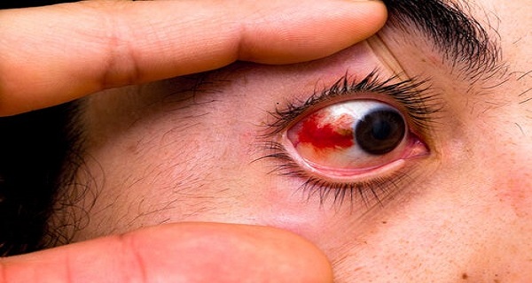 Subconjuctival Hemorrhage or Red Spots on the Eyes Why Do