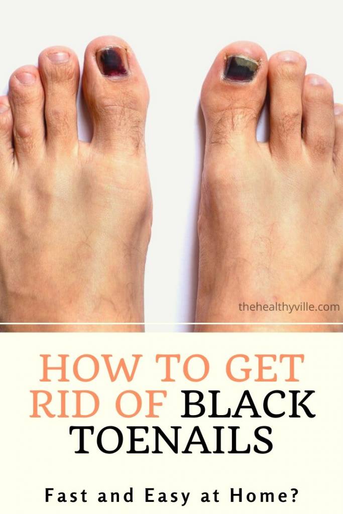 How to Get Rid of Black Toenails Fast and Easy at Home_