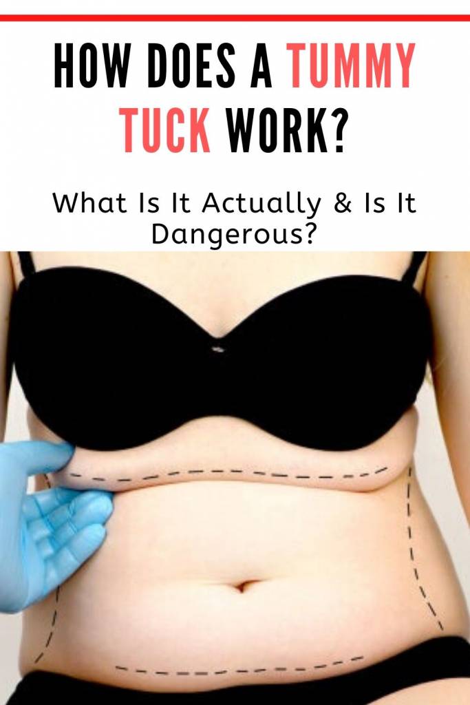 How Does a Tummy Tuck Work_ What Is It Actually_ Is It Dangerous_