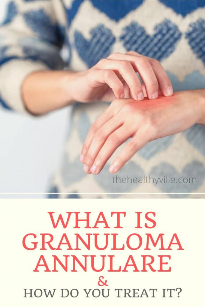 What Is Granuloma Annulare and How Do You Treat It_