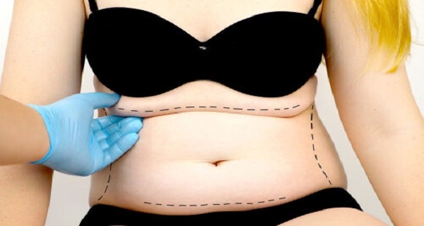 how does a tummy tuck work
