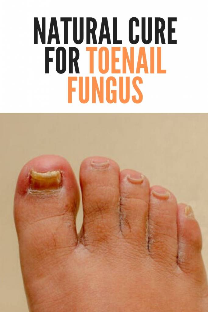 Natural Cure for Toenail Fungus – How Do Remedies Work_