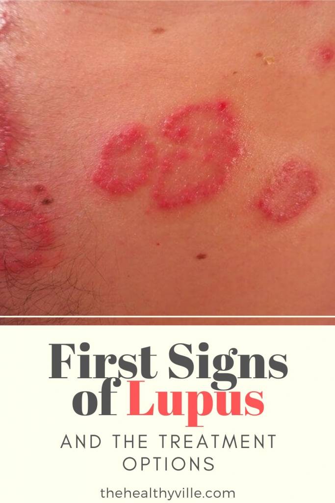 Know the First Signs of Lupus and the Treatment Options