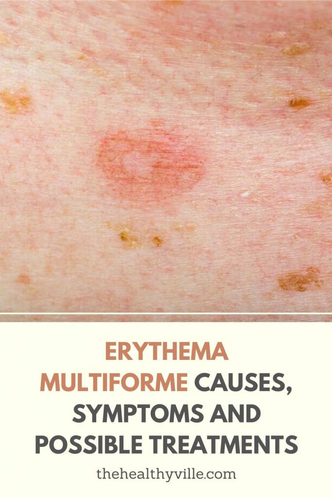 Erythema Multiforme Causes, Symptoms and Possible Treatments