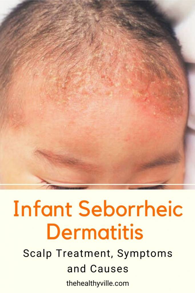 Infant Seborrheic Dermatitis Scalp Treatment, Symptoms and Causes