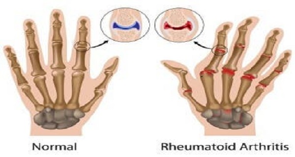 Does Rheumatoid Arthritis Go Away and How to Control the Pain?