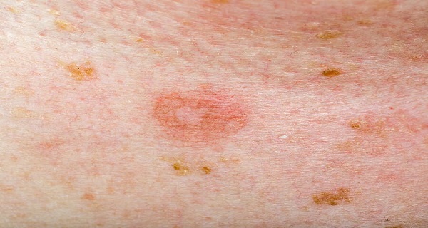 Erythema Multiforme Causes Symptoms And Possible Treatments Images